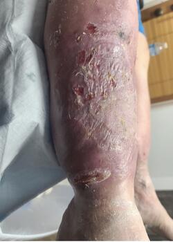 Initial lateral view