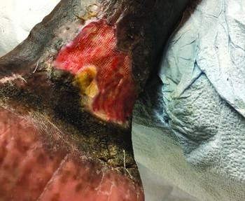 VLU occurrence can be a combination of genetic and environmental factors, theorized to be about a 70 to 30 ratio of environmental to genetic factors, respectively.