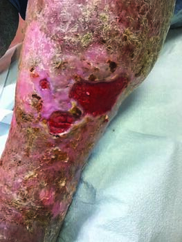 Optimal management of VLUs, such as those as seen in this photo, should include throrough evaluation of the patient’s vascular system due to in part to risk of venous thromboembolism.