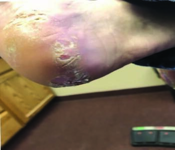 The patient presented with a several years-long history of a painful, itchy rash on his right foot, originally diagnosed with tinea pedis by his primary care physician. Topical antifungal and corticosteroid cream did not improve his symptoms.