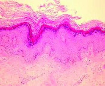 The biopsy revealed epidermal acanthosis and digitated hyperplasia with slight accentuation of the granular cell layer.
