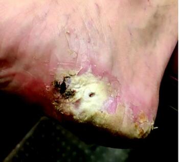 In the photo above, one can see clinical results of the chosen treatment course after two weeks.