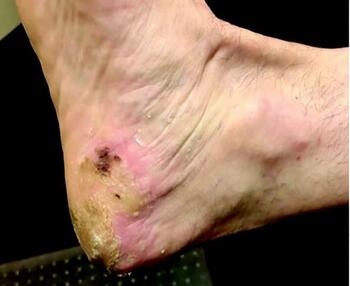 This photo illustrates near resolution after undergoing four weeks of treatment for verruca vulgaris.