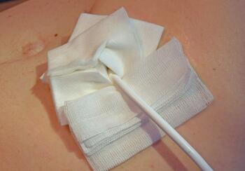 A ventricular assist device (VAD) is a manmade electromechanical pump implanted in either the right or left ventricle (or both) that assists the heart in circulating blood. 