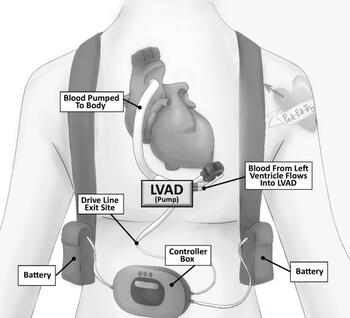 The basic components of an LVAD and what they do