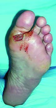 Here one can see a plantar diabetic foot ulceration. Fifty-nine to 85 percent of DFUs are polymicrobial due to the ability of various pathogens to form their own microcolonies within the biofilm.
