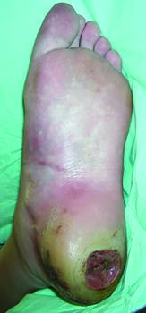 This photo illustrates a plantar heel ulceration prior to debridement. Debridement is the most clinically and cost-effective method of disrupting biofilms.