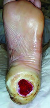 This photo illustrates a plantar heel ulceration  following debridement and application of negative pressure wound therapy. Debridement is the most clinically and cost-effective method of disrupting biofilms.