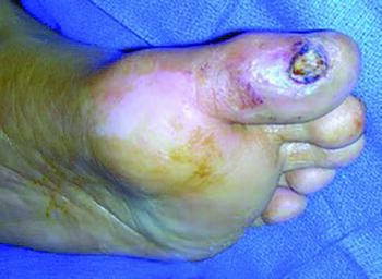 Here one can see a plantar hallux ulceration prior to debridement. Recommendations for treatment of biofilm in such ulcers include: identification of offending microorganisms; biofilm disruption; and topical and/or systemic treatment.
