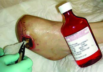 This photo illustrates use of quarter-strength (0.125%) Dakin’s solution on a foot ulceration. While several solutions are used in practice for wound disinfection, published literature on their efficacy for biofilm management are lacking.