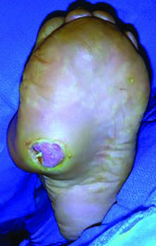 Here one can see a Wagner grade 3 DFU before incision and drainage.