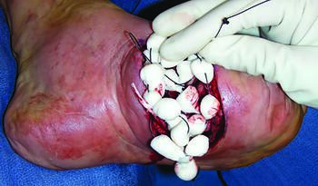 Here one can see a Wagner grade 3 DFUduring placement of antibiotic impregnated beads. Absorbable or non-absorbable beads impregnated with heat-stable antibiotics can reduce bacterial load when combined with aggressive surgical debridement.
