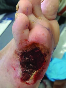 Here one can see a wound in a patient with chronic limb threatening ischemia, with decreased toe pressures and failure to heal, but not yet critical limb ischemia. Photo courtesy of Adam L. Isaac, DPM