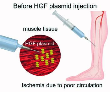 These figures further detail the use of HGF Plasmid (Collategene®), approved in Japan and currently undergoing evaluation in a Phase II clinical trial in the United States. The purpose of the study is to evaluate patients with mild to moderate CLTI, as defined by the WIfI classification, grade 1 or 2. Figure courtesy of AnGes Japan.