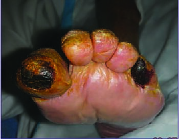 Here one can see gangrenous wounds associated with peripheral arterial disease. For many reasons, revascularization may not always be an option. Photo courtesy of Kazu Suzuki, DPM, CWS.