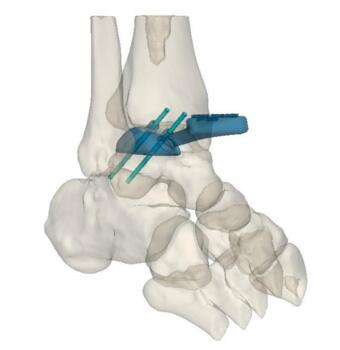 Computer drawing with proposed position and orientation of two pegs for final implant to achieve increased surface area for bone ingrowth and stability. Permission granted by Restor3D. 
