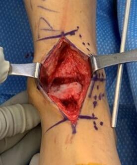 Intraoperative photograph showing the anterior ankle incision. Note the large defect of the lateral talar dome.