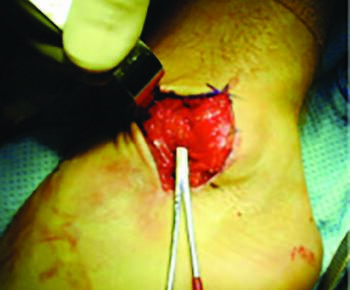 Photo courtesy of Bradly Bussewitz, DPM and Christopher Hyer, DPM FACFAS