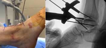 Intraoperative (left) and fluoroscopic (right) image of the cut guide. Note the reciprocating saw blade following the guide to make the osteotomy.  