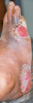 A patient can become acutely malnourished even when meeting everyday nutritional needs, because metabolic demands increase in the presence of injuries such as wounds as seen here.