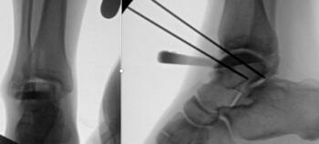 Intraoperative fluoroscopic images using the provided sizers for finding appropriate fit for implantation.