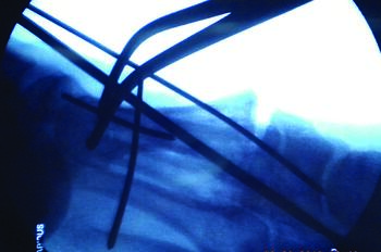 This intraoperative lateral view demonstrates good bone-to-bone contact on the inferior cortices. Note the first metatarsal positioned in the sagittal plane to reproduce the load bearing along with dorsal gapping of the first tarsometatarsal joint, repositioning the first metatarsal relative to the cuneiform in the sagittal plane. This view demonstrates good position maintained with multiple K-wire fixation and a Weber clamp for intermetatarsal angle reduction.