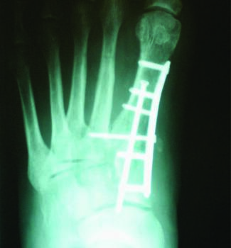 An AP postoperative view demonstrates a long solid cortical screw stabilizing the first ray coupled by a medial-based plate. The screw from first metatarsal to the second metatarsal assists in preventing elevation of the first ray and in reducing the intermetatarsal angle. Please note the first metatarsal may look “short” on the AP view as it is plantarflexed relative to the lesser metatarsals.