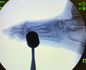This intraoperative lateral radiographic view demonstrates an elevated, unstable first ray with the foot loaded by mallet-simulated weight bearing prior to incision.