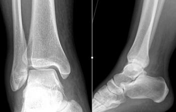 Here one can see a non-weightbearing radiographs of the original ankle injury. Note the small lucent area of the lateral talar dome.