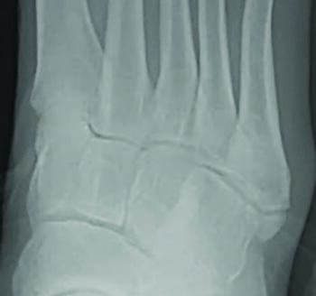 This radiographic image shows a Zone 1 fracture, but one can easily confused this with a Jones fracture. This type of fracture is often referred to as a pseudo-Jones fracture. Note the fracture line extends into the metatarsocuboid joint.