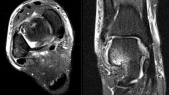 This MRI STIR image from two months out of injury shows the bone edema and unstable talar dome osteochondral inury. 