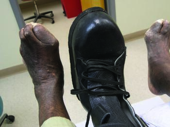The authors contend that custom molded shoes are best considered for foot shapes many commercial lasts on the market cannot accommodate, used as a patient’s final footwear, but never as a wound healing device.