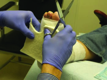 In this photo, one can see the felted foam-in-dressing technique. The authors relate modifying the technique to avoid taping the felt to the skin and place the offloading padding outside the initial contact and secondary dressing layers.
