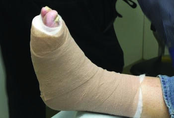 This photo shows an example of the modified football dressing with the toes exposed. Specfiically, the Rader football dressing, uses adhesive foam and a thick, multilayer, non-removable padded dressing secured by self-adherent wraps.