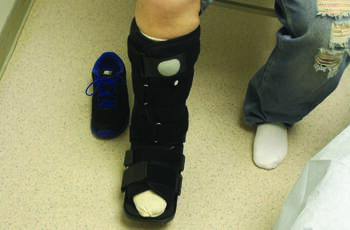 In this photo, one can see a removable cast walker, inside which the patient has a modified football dressing. This style of dressing can provide a level of nonremovable offloading to a removable shoe or walker system.
