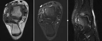 This MRI image shows cystic changes of the lateral talar dome. The lesion is large and has a more lobulated cystic change. Note the anchor in the calcaneus from the prior ankle stabilization.