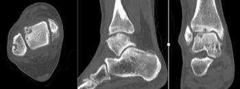 This CT image shows the increasing width and depth of the lateral talar dome pathology. Note the loss of the lateral shoulder.