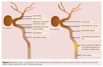 Complication of Flow Diverter During Treatment of ICA Aneurysm Fig4