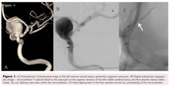 Complication of Flow Diverter During Treatment of ICA Aneurysm Fig1
