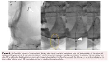 Complication of Flow Diverter During Treatment of ICA Aneurysm Fig2