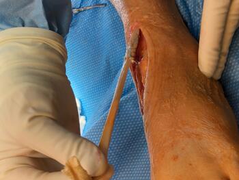 Here one can see as the surgeon prepares an appropriately sized tendon allograft (donor) and  attaches it to the proximal tendon segment (recipient) using the surgeon's preferred attachment technique.