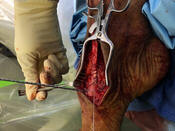 This photo shows placement of a whip stitch on the distal end of the tendon.
