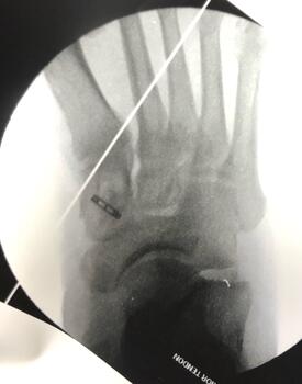 Fluoroscopy confirms the button has flipped and is in proper position, sitting flush against the plantar cortex.
