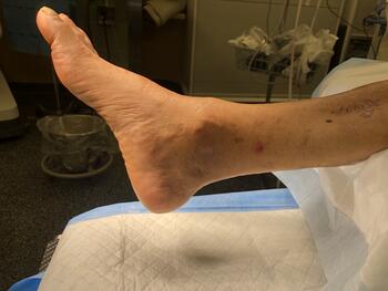 Patients may present with a painless mass, or pseudotumor, along the anterior medial aspect of the ankle joint.