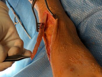 In this photo, the surgeon identifies and proximally frees the tibialis anterior tendon stump.