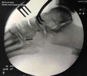 Fluoroscopy confirms the button has flipped and is in proper position, sitting flush against the plantar cortex.