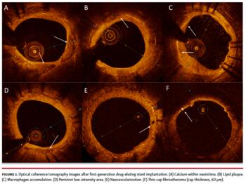 Optical coherence tomography images after first-generation drug-eluting stent implantation