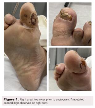 Pedal-Plantar Loop in Lower Extremity Angiographic Interventions Fig1