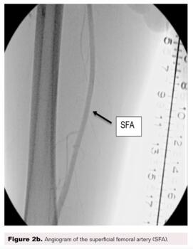 Pedal-Plantar Loop in Lower Extremity Angiographic Interventions Fig2b