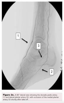 Pedal-Plantar Loop in Lower Extremity Angiographic Interventions Fig2e